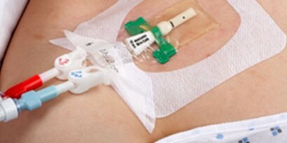Soluções de acesso vascular
