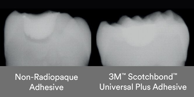 Comparação entre a sombra do adesivo não-radiopaco e o adesivo radiopaco Scotchbond Universal Plus
