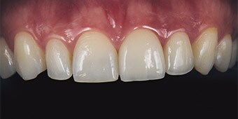 Resultado do tratamento com uma faceta feita de cerâmica feldspática e uma coroa revestida manualmente com uma capa feita de Zircónio 3M™ Lava™ Frame.

