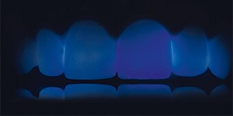 Translucidez das restaurações e dos dentes adjacentes em luz azul transmitida.
