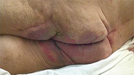 Dermatites Associadas à Incontinência (DAI)
