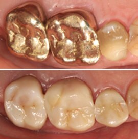  Zircónia de Translucidez Elevada Lava™ Plus