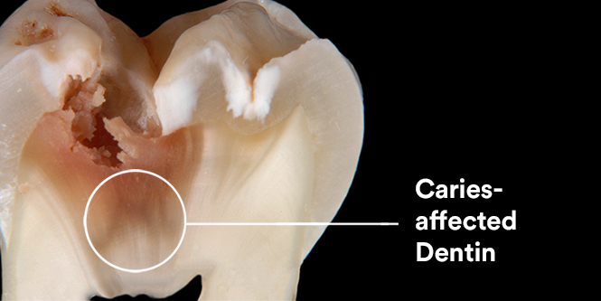Zonas de cárie com dentina afetada
