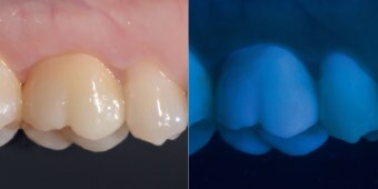 Vista lateral da coroa monolítica no primeiro molar (esquerda).  Fotografia tirada sob luz ultravioleta: O material de zircónio apresenta uma fluorescência semelhante aos dentes naturais (direita).*
