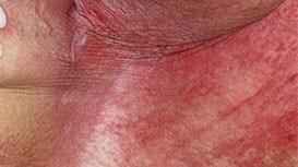 Dermatite Intertrigosa (DI)
