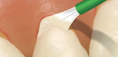 Tratar (Tratamento com Flúor)
