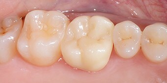 Coroa monolítica feita em Zircónio Fluorescente de Contorno Total Estético 3M™ Lava™.
